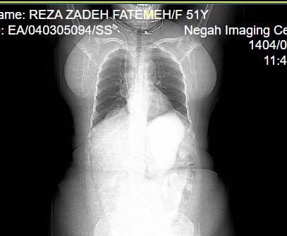 تشخیص COPD با فیلم رادیولوژی PPQ